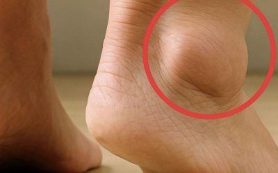 Swollen Feet in Older Adults: Common Causes and Prevention