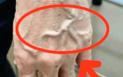 If Someone Has Visible Veins, Does It Mean Their Circulation Is Poor?