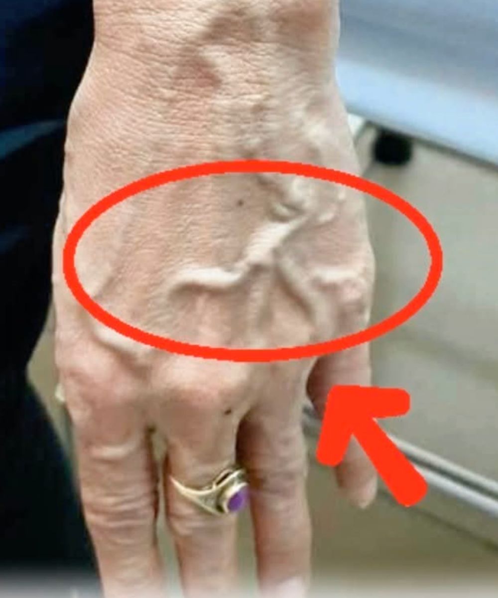 If Someone Has Visible Veins, Does It Mean Their Circulation Is Poor?