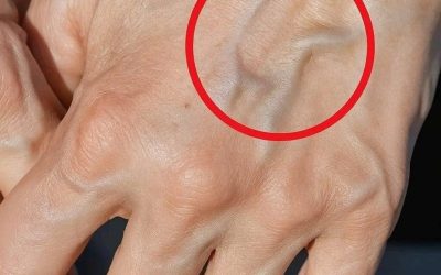 Visible Veins: The Real Reasons and Consequences for Your Health