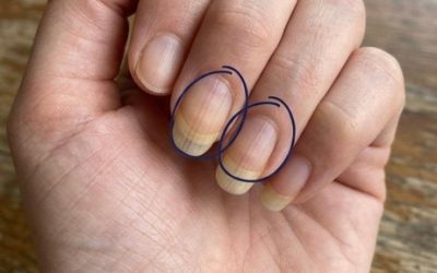 If You Have Ripples on Your Nails, Here’s What They Mean