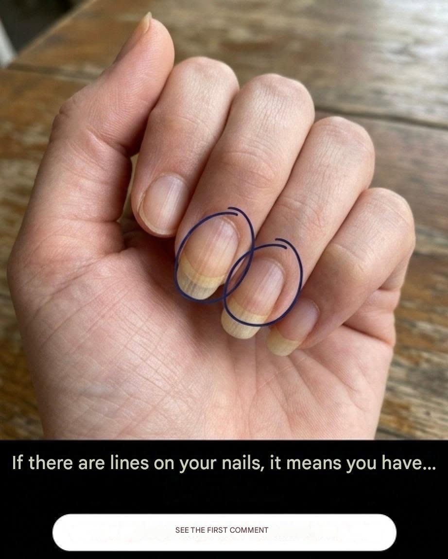If You Have Ripples on Your Nails, Here’s What They Mean
