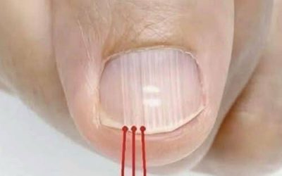 If you have these lines on your nails after 40, it is a clear sign that..