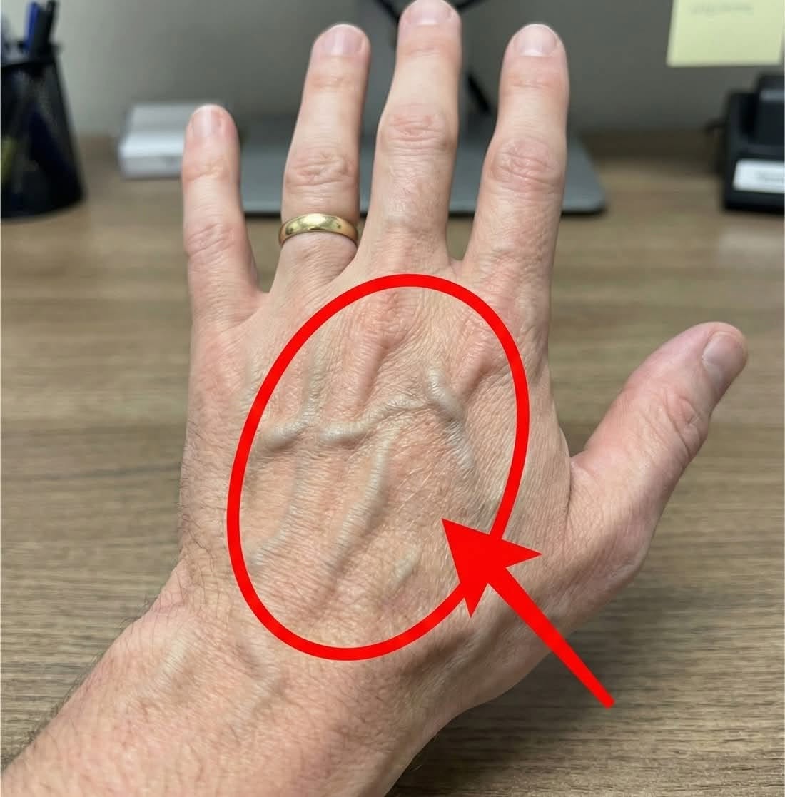 If Someone Has Visible Veins, Does It Mean Their Circulation Is Poor?