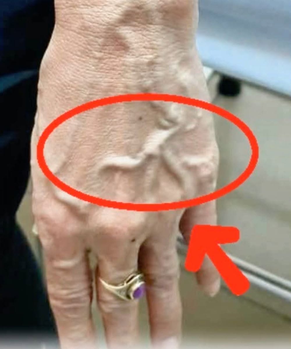 If Someone Has Visible Veins, Does It Mean Their Circulation Is Poor?