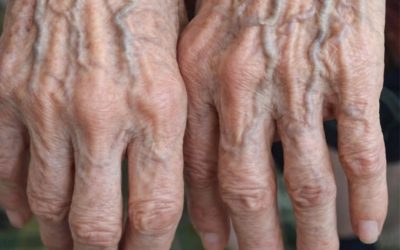 Bulging Veins …When They’re Harmless and When They Could Signal a Problem