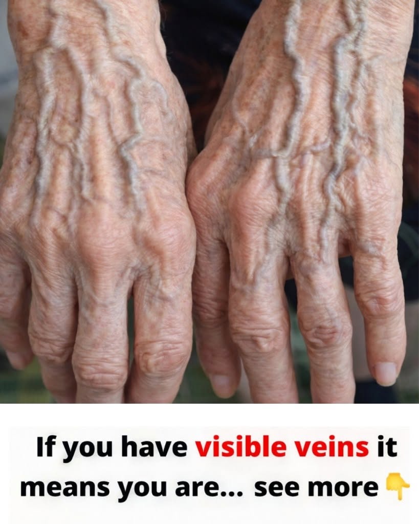 Bulging Veins …When They’re Harmless and When They Could Signal a Problem
