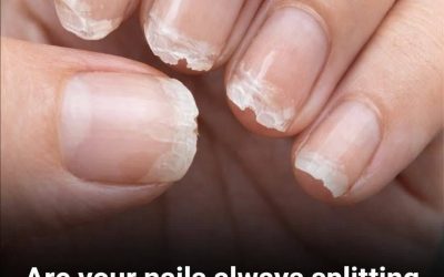 Brittle or fragile nails: what your body is trying to tell you