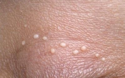 Tiny white bumps keep showing up on my eyelids, and I can’t get in to be seen yet. What are these?