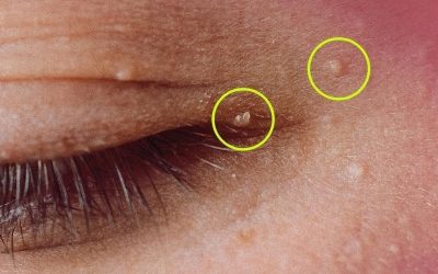 How to Get Rid of Milia: Those Annoying Fat Cysts