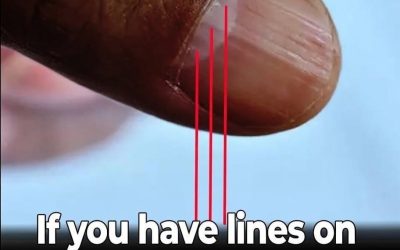 Lines on your nails may indicate nutritional deficiencies or other health issues.