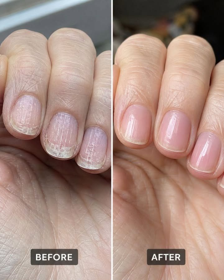 Soak your nails in this 1 mixture and get rid of brittle ridges, vertical lines, and flaky layers