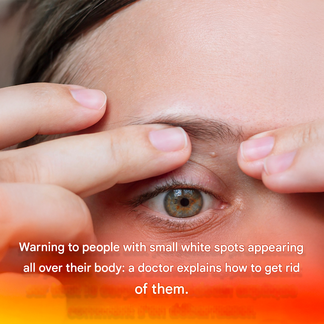 Warning to people with small white spots appearing all over their body: a doctor explains how to get rid of them