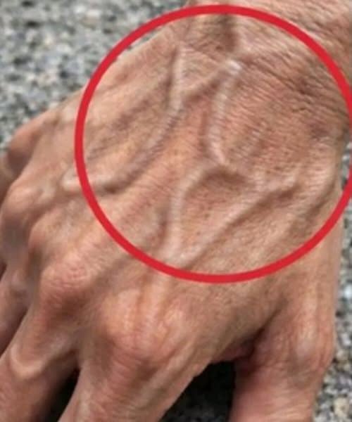 If Someone Has Visible Veins, Does It Mean Their Circulation Is Poor?