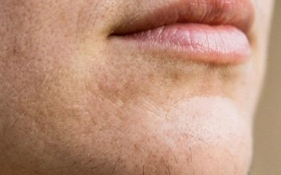 Chin hair on a woman is a sign of…