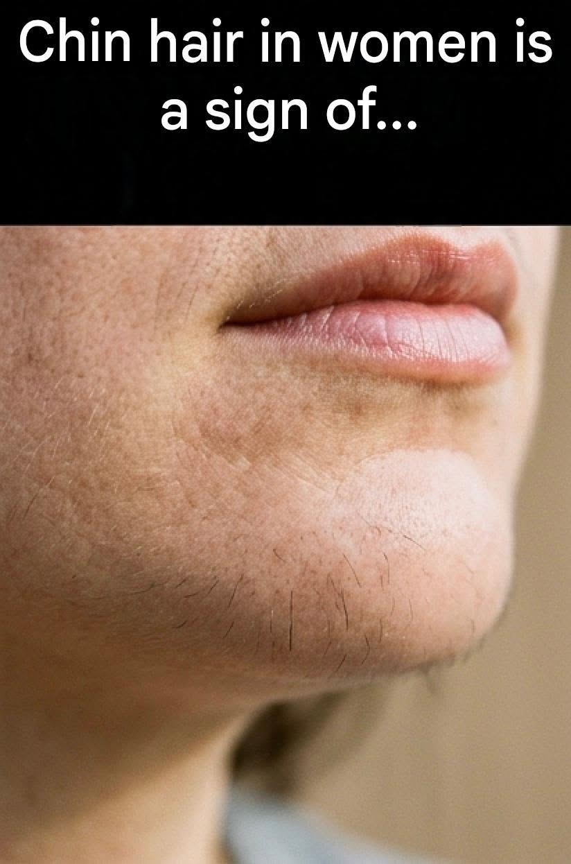 Chin hair on a woman is a sign of…