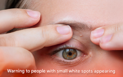 Warning to people with small white spots appearing all over their body: a doctor explains how to get rid of them